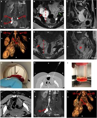CT-Guided Aspiration of a Hemorrhagic Tarlov Cyst for the Treatment of a Post-Partum Sciatica: A Case Report and a Review of the Literature